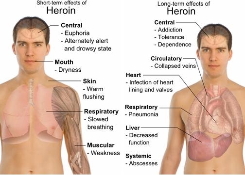 short-and-long-term-effects-of-heroin